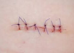 Suture